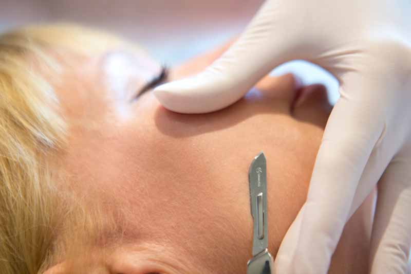 Dermaplaning_Project_Skin_Vancouver_medical_spa