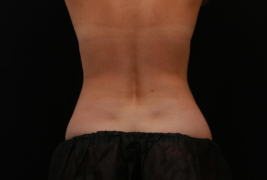 coolsculpting-results-slimming-skin-treatments