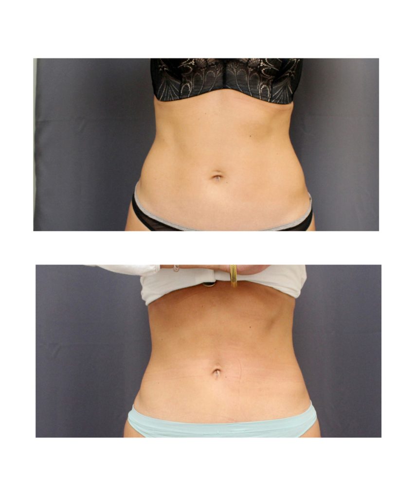 All About the CoolSculpting Treatment